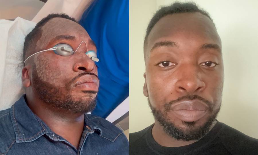 Man before and after UltraClear laser facial