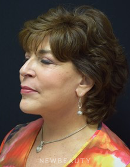 Dr. Jeffrey B. Wise - Deep Plane Facelift - After