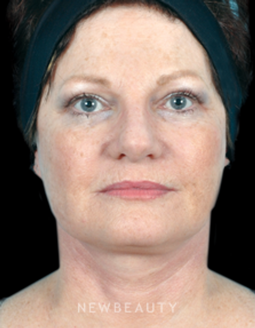 Dr. Bradley Bengtson - Facial Rejuvenation - After