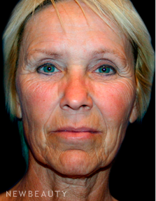 Dr. Kelly Bomer Facelift - Before