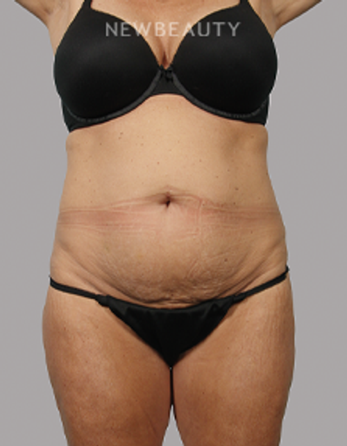 Dr. Michael McNeel - Tightening Transformation - 44726082 - Before