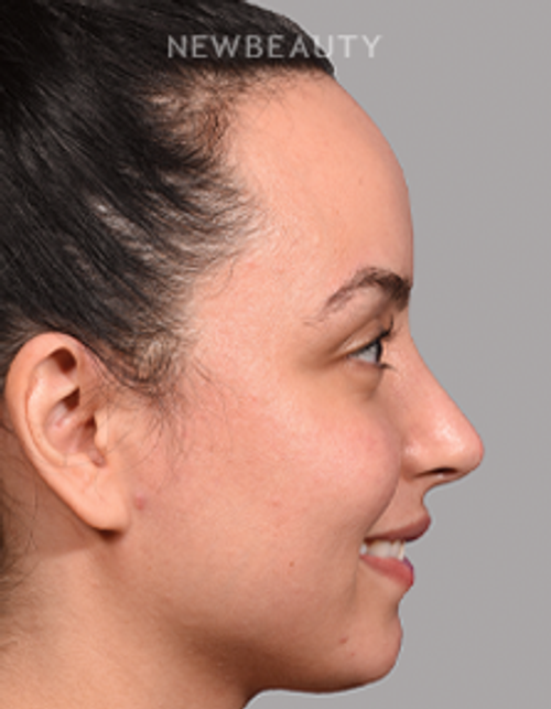 Sam P Most, MD - 21009812 - Rhibnoplasty - After