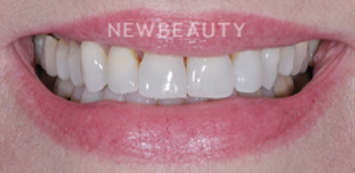 Dr. Salvator La Mastra- Smile Makeover -46107717 - Before