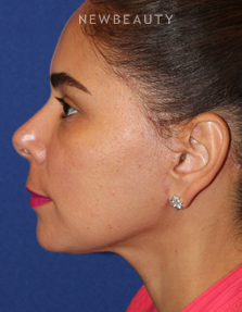 Dr. Dilip D. Madnani - Mini-Facelift - After