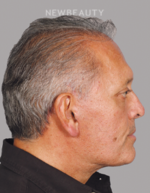 Dr. Mahabir - Traditional Facelift - 20637920 - After
