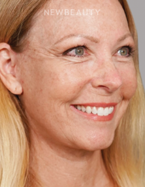 Dr. Paul Nassif - Facelift, Necklift, Upper Blepharoplasty - 51350740 - After