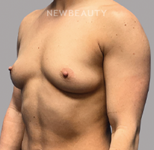 DR.PHILIPPE A.CAPRARO - Breast Augmentation - 46191053 - Before