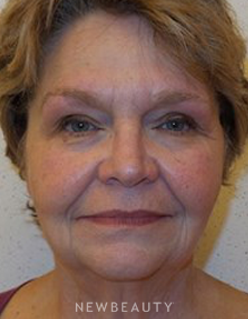 Dr. Joel Schlessinger - Botox - After