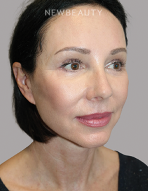 Dr. Sanjay Grover - Facelift - 49726325 - After
