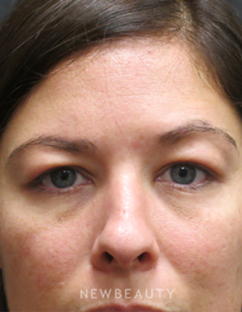 Dr. Elie Levine - Upper Blepharoplasty - Before