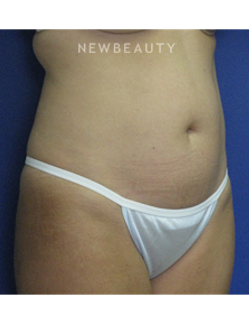 Dr. Joseph Russo - Liposuction of the Abdomen - Before