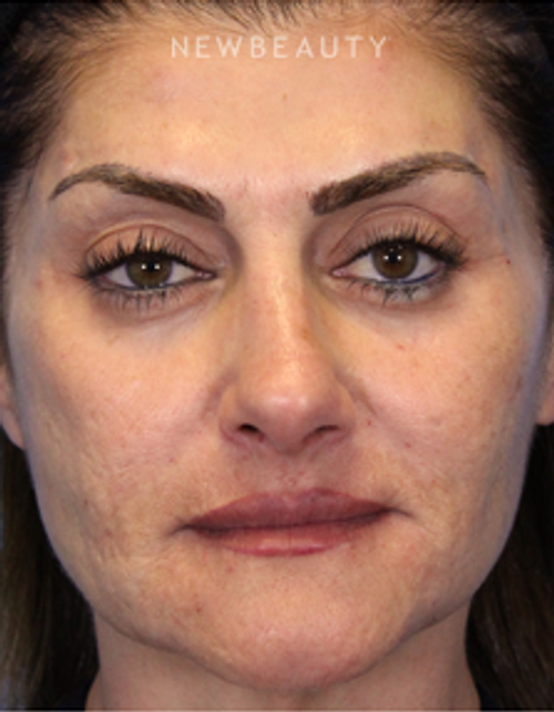 Dr. Ava Shamban - Facial Rejuvenation - Before