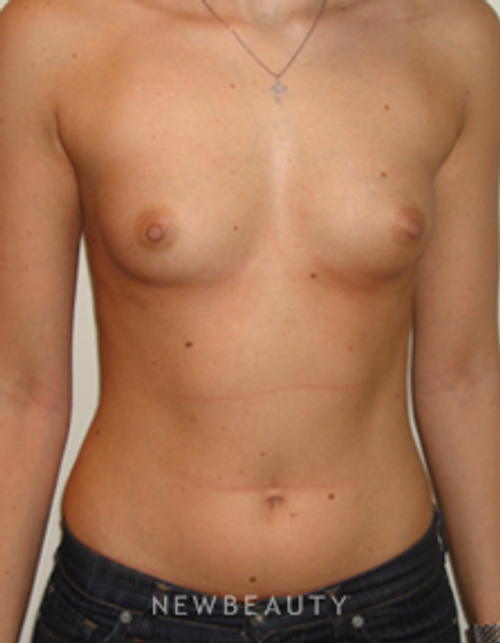 Dr. Michael Horn Breast Augmentation - Before