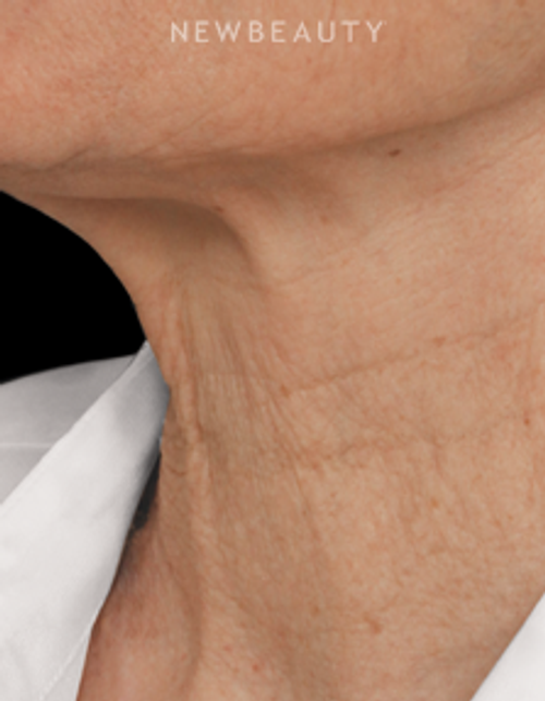 Drs. Jennifer Segal & Scott Smith - Microneedling - Before