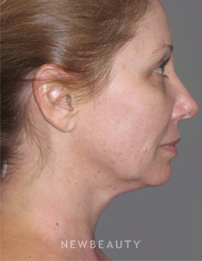 Dr. Min Ahn - Mini-Facelift & Necklift - Before