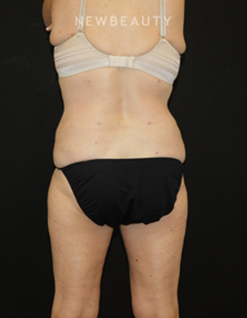Dr. Joel Schlessinger - Smart Lipo - After