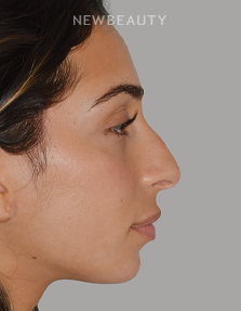 Dr. Anthony Bared - Rhinoplasty - 46164855 - Before