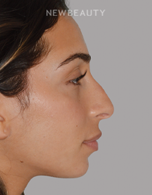Dr. Anthony Bared - Rhinoplasty - 46164855 - Before