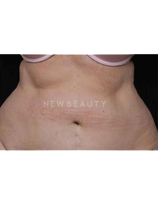 Dr. Ruth Hillelson Coolsculpting by Zeltiq - After