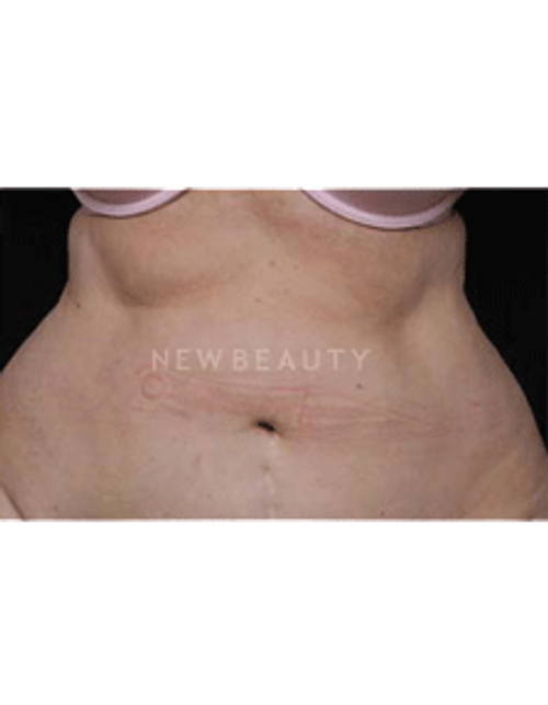 Dr. Ruth Hillelson Coolsculpting by Zeltiq - After
