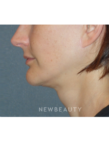 Dr. Min Ahn - Mini-Facelift With Necklift - After