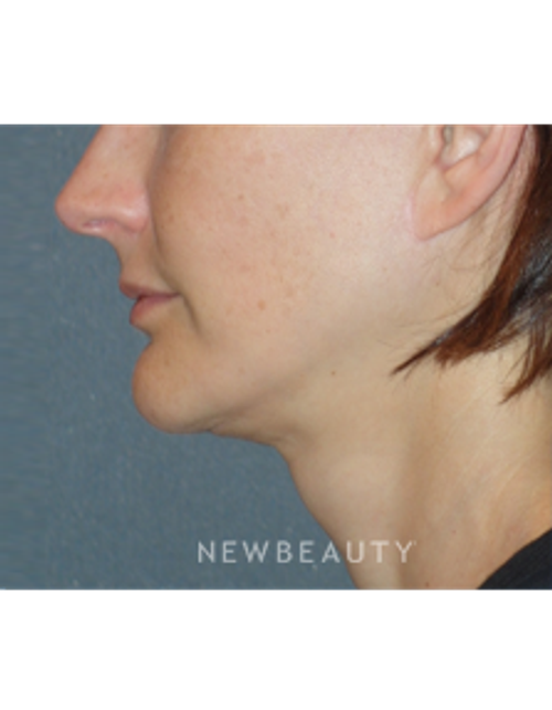 Dr. Min Ahn - Mini-Facelift With Necklift - After