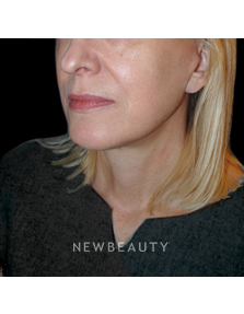 Dr. Lee Ann M. Klausner - Skin Rejuvenation - After