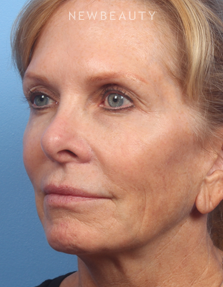 Dr. Kelly Bomer - Liquid Facelift - Before