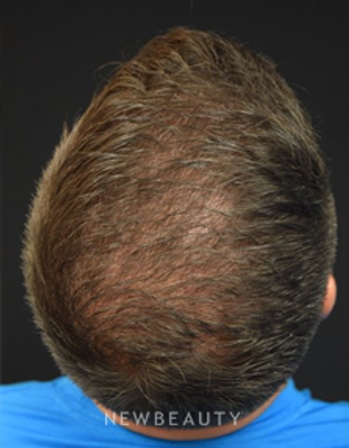 Dr. Jeffrey Rapaport - Hair Transplant - After
