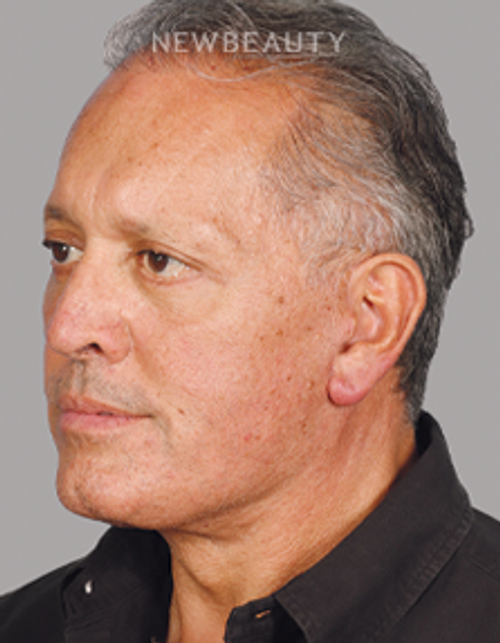 Dr. Mahabir - Traditional Facelift - 20637920 - After