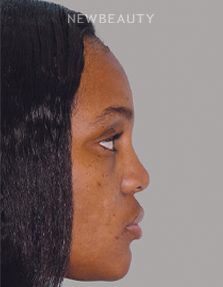 Dr. Anthony Bared - Rhinoplasty - 46164771 - Before