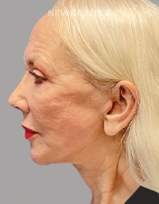 Dr. Paul Afrooz - Facelift - 34805495 - After