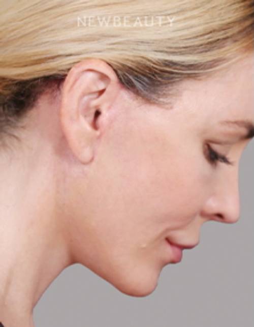 Dr. Paul Nassif - Deep Plane Facelift & Necklift - 51351578 - After