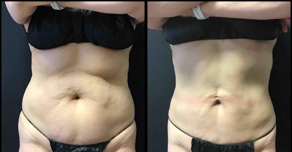 tiffany-mccormack-cooltone-coolsculpt