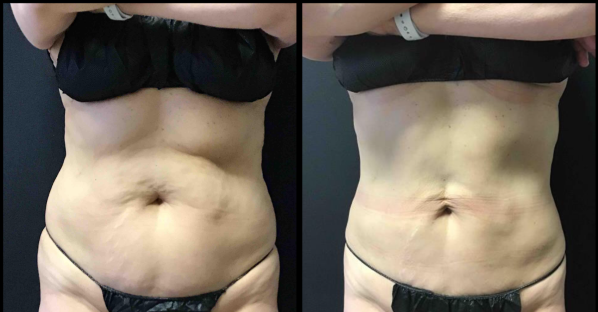 tiffany-mccormack-cooltone-coolsculpt