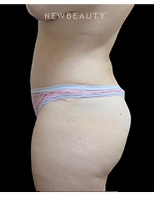 Dr. Elie Levine - Mommy Makeover - After