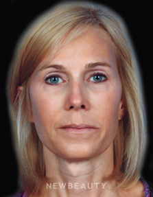 Dr. Kelly Bomer Liquid Facelift - After