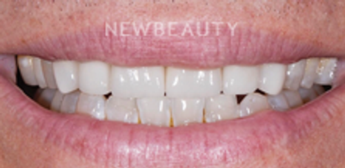 Dr. Salvator La Mastra – Smile Makeover – 46107063 - After
