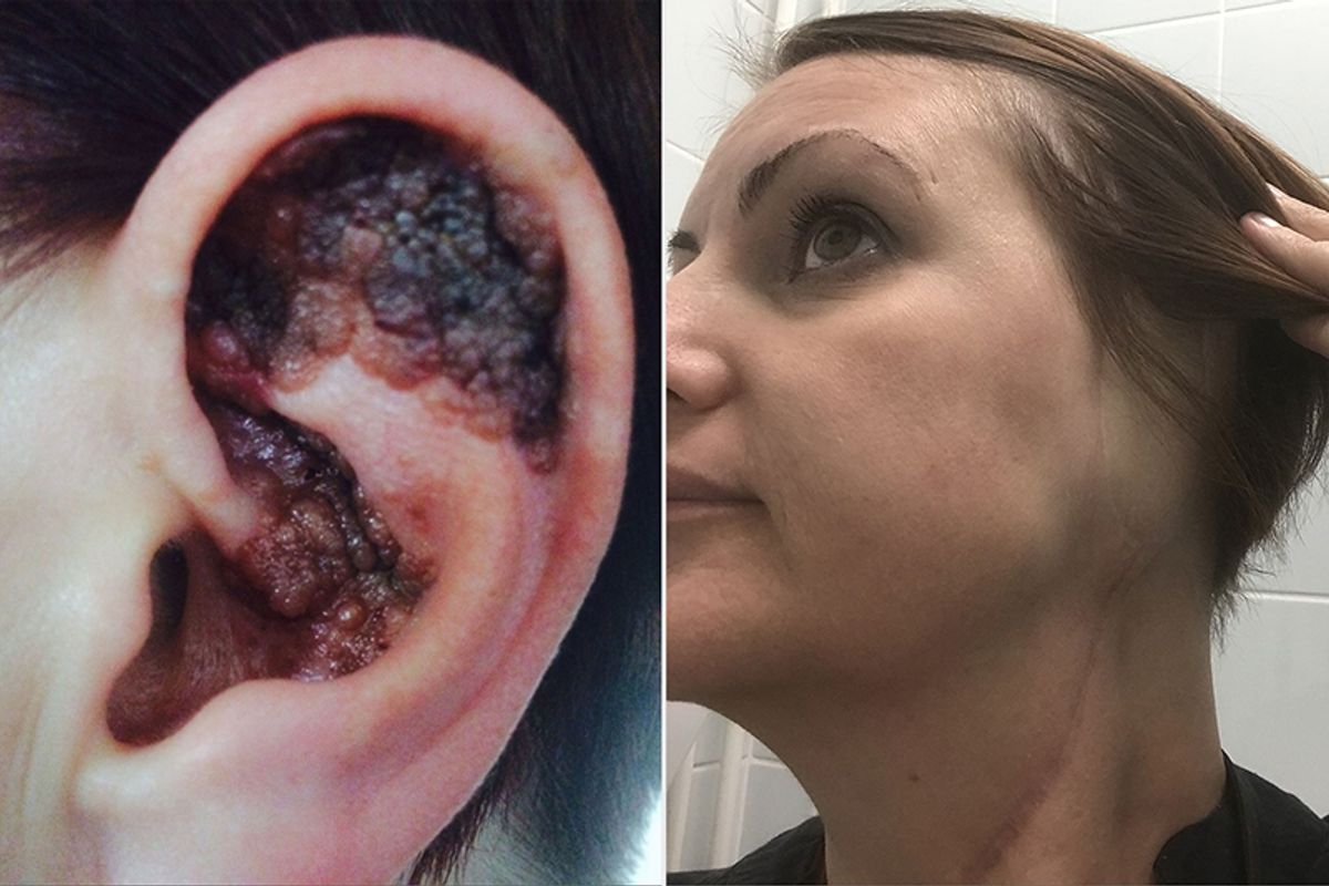 PIC FROM Kennedy News and Media (PICTURED: THE MALIGNANT MELANOMA ON ANTHEA SMITH'S EAR) A mum is calling for a sunbed ban in the UK after her entire ear had to be amputated when a giant aggressive skin cancer engulfed it - which doctors dismissed as a WART for FIVE years. Anthea Smith blames her 'naive' use of sunbeds since the age of just 14 for her devastating diagnosis of malignant melanoma, which cost her left ear, lymph nodes, temporal bone and salivary glands. Horrendous photos show the 43-year-old's ear transform from having a small red lump to being covered by the black and brown warty-growth in five years. SEE KENNEDY NEWS COPY - 0161 697 4266PIC FROM Kennedy News and Media (PICTURED: ANTHEA SMITH PICTURED AFTER HER EAR AMPUTATION) A mum is calling for a sunbed ban in the UK after her entire ear had to be amputated when a giant aggressive skin cancer engulfed it - which doctors dismissed as a WART for FIVE years. Anthea Smith blames her 'naive' use of sunbeds since the age of just 14 for her devastating diagnosis of malignant melanoma, which cost her left ear, lymph nodes, temporal bone and salivary glands. Horrendous photos show the 43-year-old's ear transform from having a small red lump to being covered by the black and brown warty-growth in five years. SEE KENNEDY NEWS COPY - 0161 697 4266