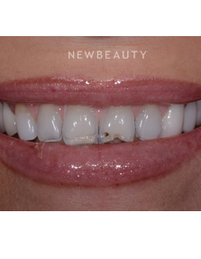 Dr. Guy Lewis - Crowns & Veneers - Before