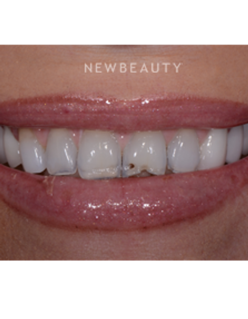 Dr. Guy Lewis - Crowns & Veneers - Before