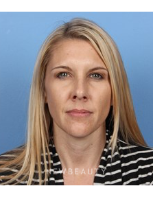 Dr. Kelly Bomer - Botox - After