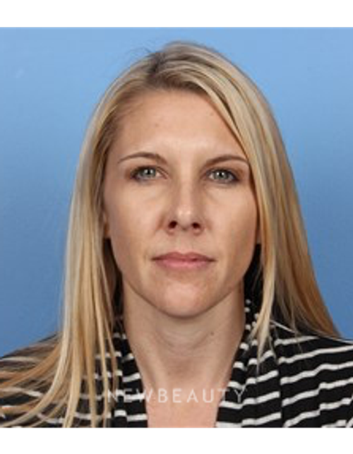 Dr. Kelly Bomer - Botox - After