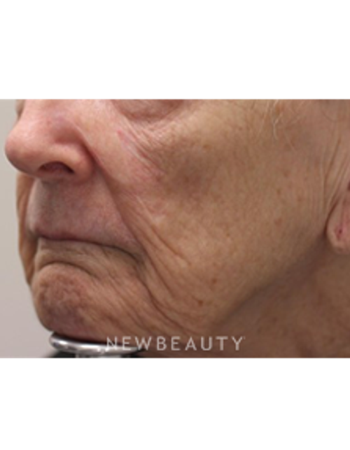 Dr. Gilly Munavalli - Lasers - Before