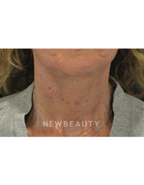 Dr. B. Aviva Preminger - Neck Lift - After