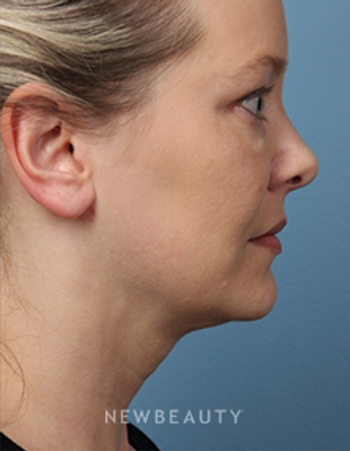 Dr. Kathleen Behr - SmartLipo - After