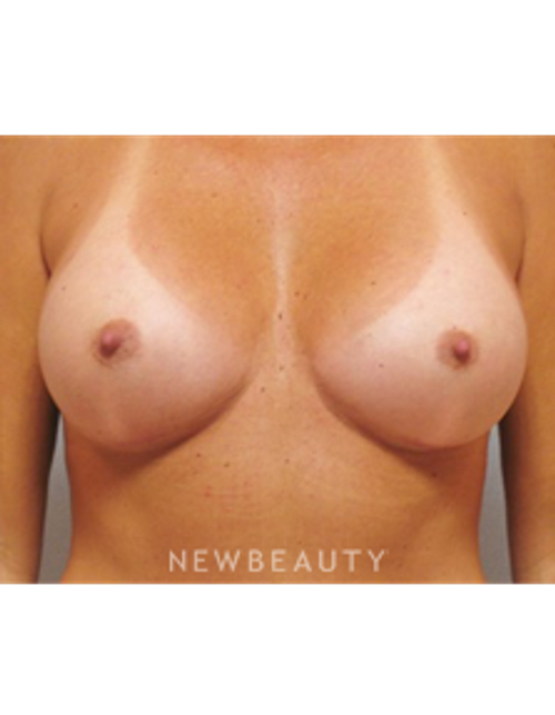 Dr. German Newall - Breast Augmentation - After