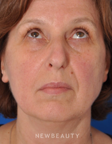 Dr. Edward Kwak - Rhinoplasty - Before