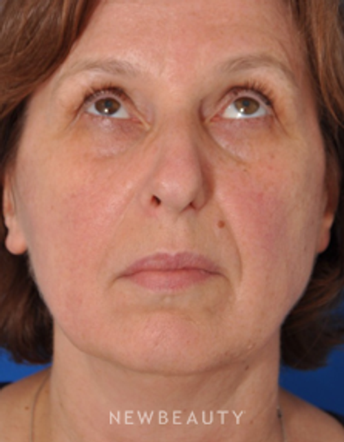 Dr. Edward Kwak - Rhinoplasty - Before