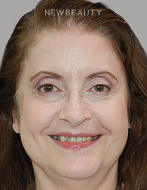 Dr. Salvator La Mastra - Smile Makeover -46108303 - Before